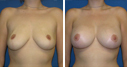 Before & After Photos